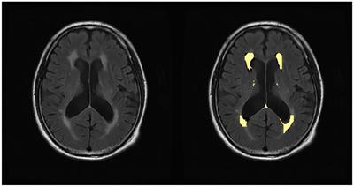 Retinal thickness changes in different subfields reflect the volume change of cerebral white matter hyperintensity